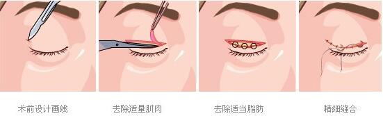 割双眼皮手术的比较好年龄是多少 割双眼皮手术应注意什么