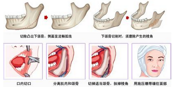 秦皇岛巧致整形医院磨下颌角要多少钱?有风险吗?