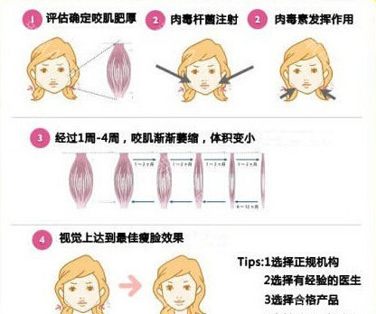 秦皇岛巧致整形医院磨下颌角要多少钱?有风险吗?