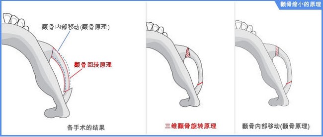 韩国颧骨整形手术一般要多少钱 韩国颧骨整形手术前后对比案例果照片图