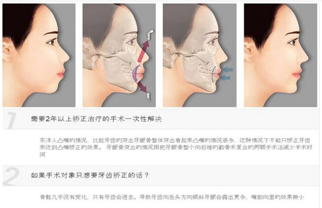 韩国突嘴手术的费用是多少 韩国突嘴手术危险性
