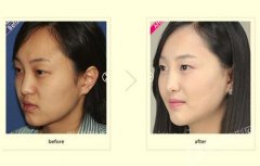 韩国vline的脸型手术价格