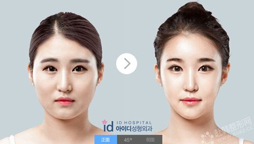 韩国vline的脸型手术价格