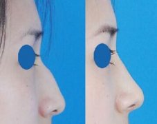 驼峰鼻矫正手术方法有哪些 驼峰鼻矫正手术降低风险吗
