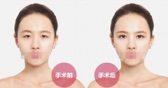 埋线双眼皮果怎么样 埋线双眼皮拆线后眼皮会松吗
