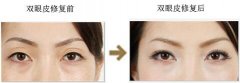 如何缩短双眼皮手术的恢复时间 割双眼皮后怎么护理