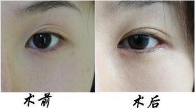 如何缩短双眼皮手术的恢复时间 割双眼皮后怎么护理