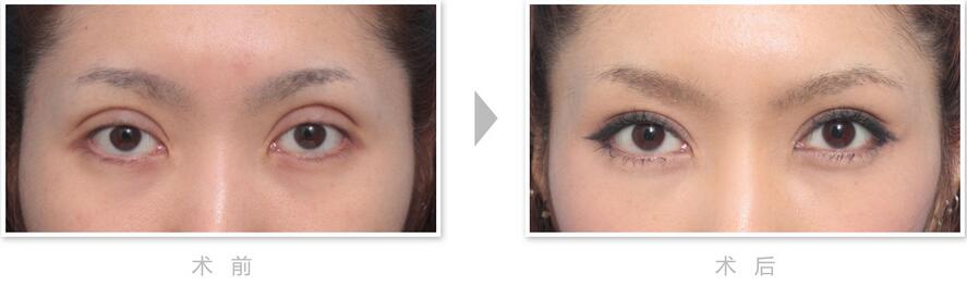 如何缩短双眼皮手术的恢复时间 割双眼皮后怎么护理