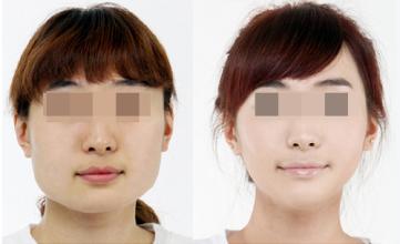 朴相熏改脸型手术费用 朴相熏截骨改脸型手术前后对比图片