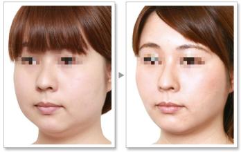 朴相熏改脸型手术费用 朴相熏截骨改脸型手术前后对比图片