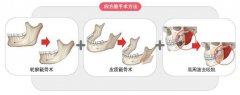 下颌角截骨手术医院哪家喜欢