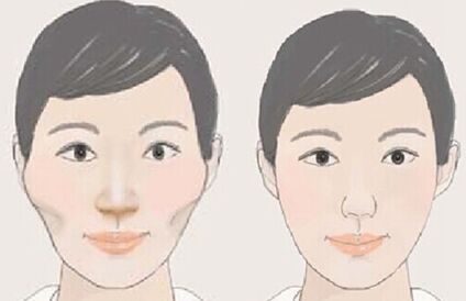 韩式磨颧骨瘦脸的危害 韩式磨颧骨瘦脸有后遗症吗