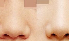 鼻孔缩小手术果怎么样 鼻孔缩小手术对比图