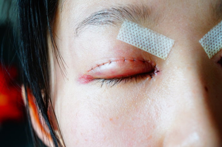 做了双眼皮开眼角手术 美丽没有后顾之忧