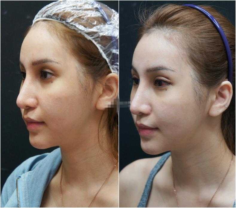 三元整形网 案例     而且,由于眼睛小,让我显得无神,黑眼球面积不大