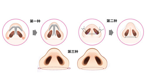 什么是鼻子缩小手术 鼻子缩小手术危险吗