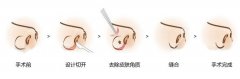什么是鼻子缩小手术 鼻子缩小手术危险吗