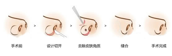 什么是鼻子缩小手术 鼻子缩小手术危险吗