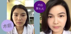 韩国太阳穴填充方法 韩国丰太阳穴手术的方法有哪些