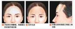 韩国自体脂肪填充额头价格 韩国自体脂肪填充额头前后对比图 韩国自体脂肪填充额头价格 韩国自体脂肪填充额头前后对比图