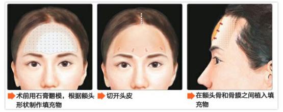 韩国自体脂肪填充额头价格 韩国自体脂肪填充额头前后对比图