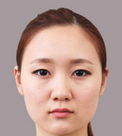 有做过改脸型手术的吗?下面请看截骨改脸型手术前后对比图片