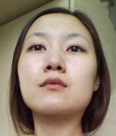 有做过改脸型手术的吗?下面请看截骨改脸型手术前后对比图片