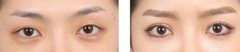 眼部综合整形的手术有哪些 眼部手术前后对比图