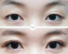 双眼皮多久可以修复、哪些人适合做双眼皮修复