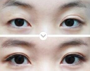 双眼皮多久可以修复,哪些人适合做双眼皮修复