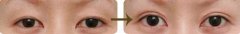 双眼皮失败的原因 修复失败双眼皮方法