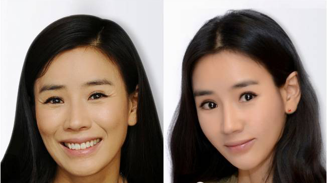 注射瘦脸注射美容多少钱 注射瘦脸注射美容前后对比图