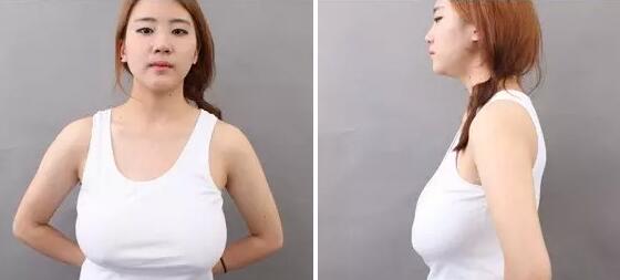 巨大乳房缩小术有后遗症吗 巨大乳房缩小术后怎么护理