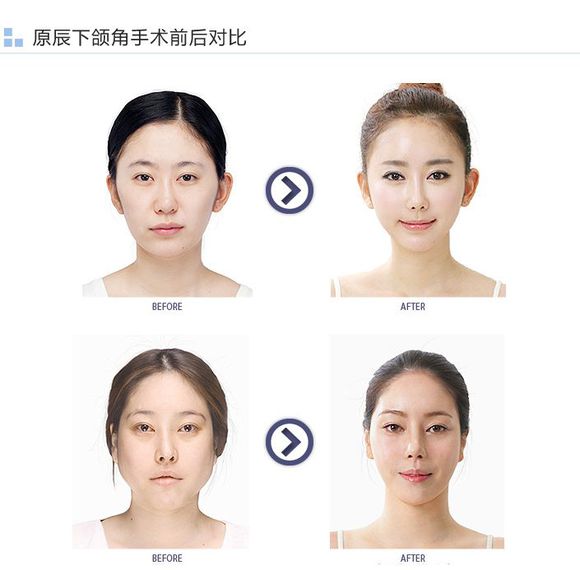 西安整形医院做下颌角手术危险吗?好吗?