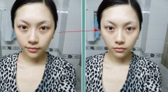 打完B****咬肌突然鼓起一块什么原因啊