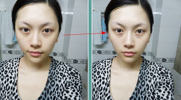 打完B****咬肌突然鼓起一块什么原因啊