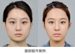【面部注射物取出】注射在面部的填充物可以取出吗? 【面部注射物取出】注射在面部的填充物可以取出吗?