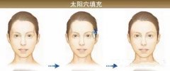自体脂肪丰太阳穴能维持多久