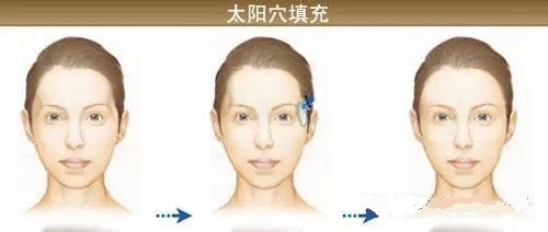 自体脂肪丰太阳穴能维持多久