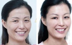 激光除皱的果 激光除皱能保持多久