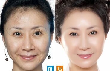 激光除皱原理,激光除皱有哪些特点