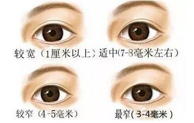 东方人做欧式双眼皮好看吗 欧式双眼皮要做多宽