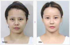 开眼角双眼皮手术怎么样 开眼角双眼皮手术会不会留疤