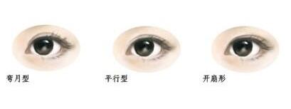 开眼角双眼皮手术怎么样 开眼角双眼皮手术会不会留疤