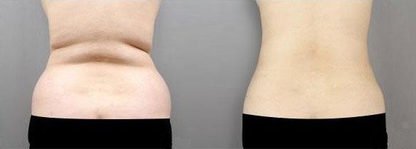 采用内窥镜收紧腹部松弛的肌肉,再结合吸脂技术吸除腹部过多脂肪