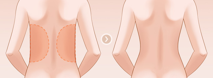 腰腹部吸脂术会伤害血管吗 腰腹部吸脂术后会反弹吗