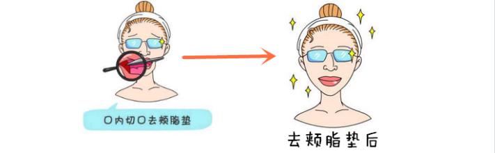 去颊脂垫手术后会不会反弹呢 去颊脂垫手术果怎么样