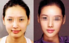 【改脸型手术】改脸型手术风险大吗 改脸型手术前后对比照片图