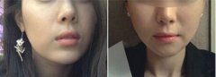 隆下巴整形手术安不降低风险 隆下巴前后对比照片图 隆下巴整形手术安不降低风险 隆下巴前后对比照片图