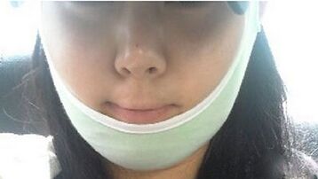 隆下巴整形手术安不降低风险 隆下巴前后对比照片图
